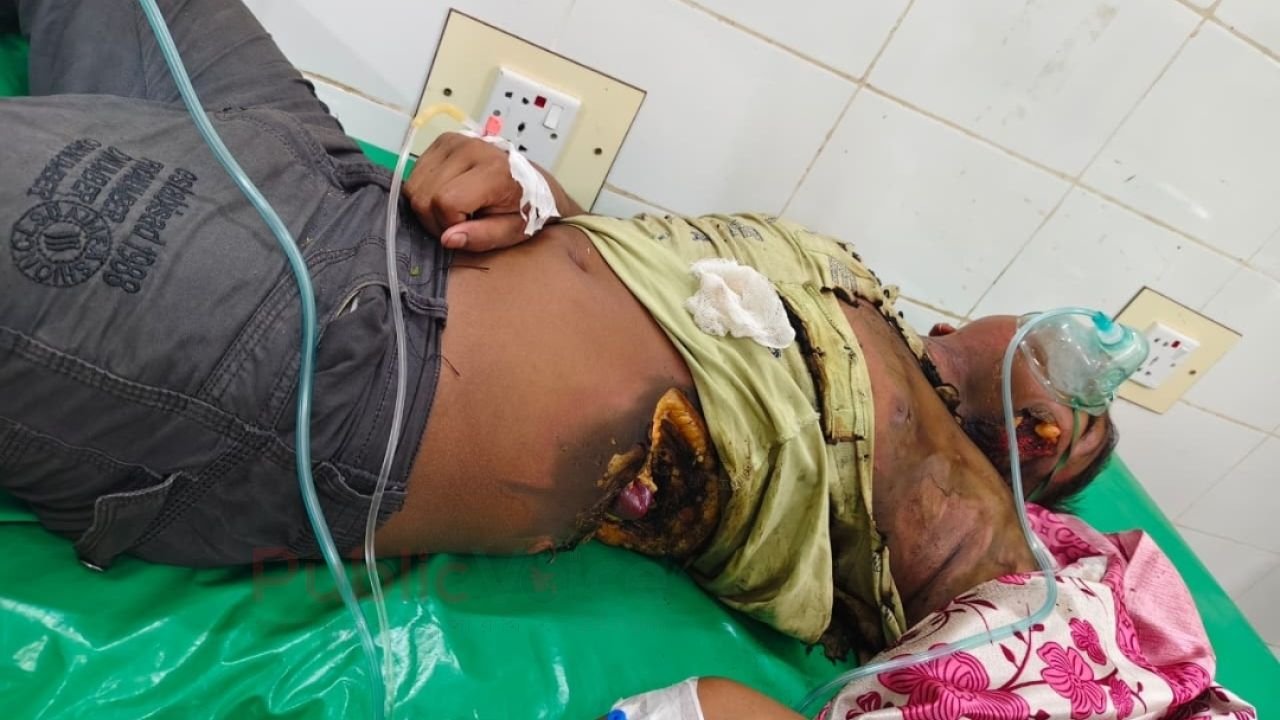 বৈদ্যুতিক শর্ট সার্কিটে গুরুতর আহত কিশোর